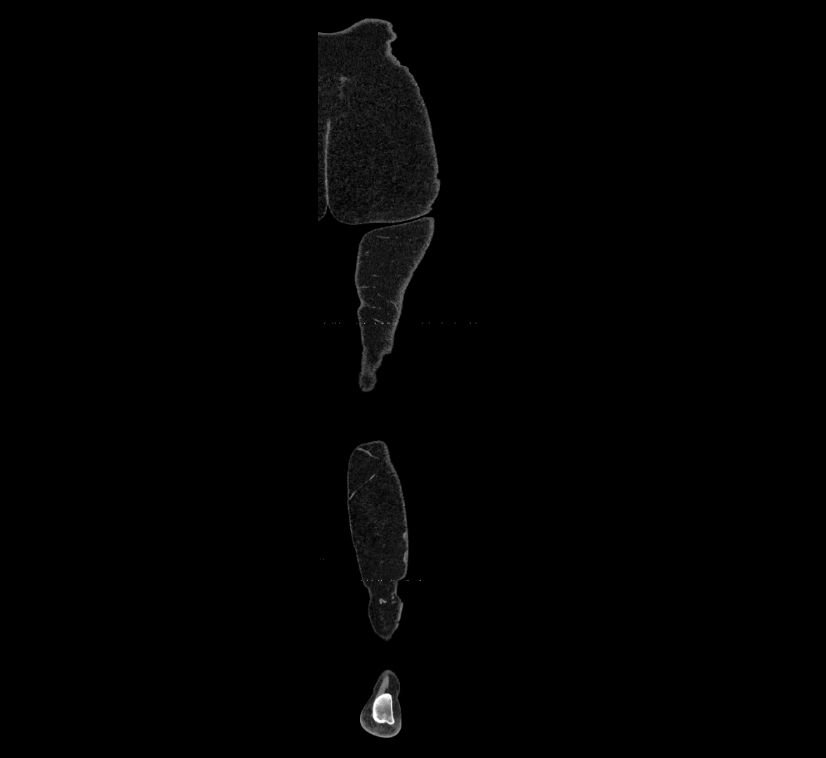 CTA lower limb coronal cross sectional anatomy labelled image _94 (2).webp